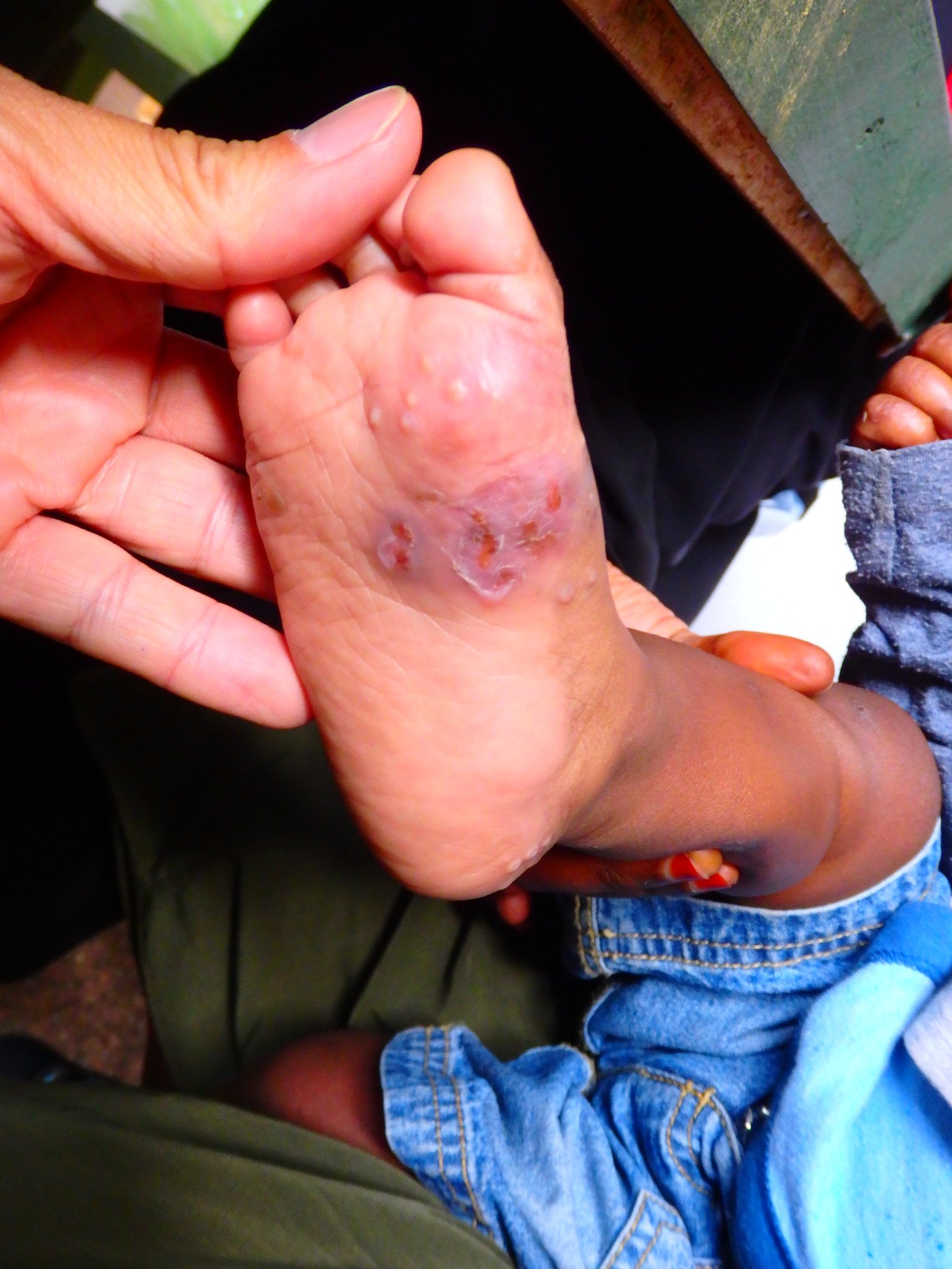 Scabies_rie2 (Tanzania)